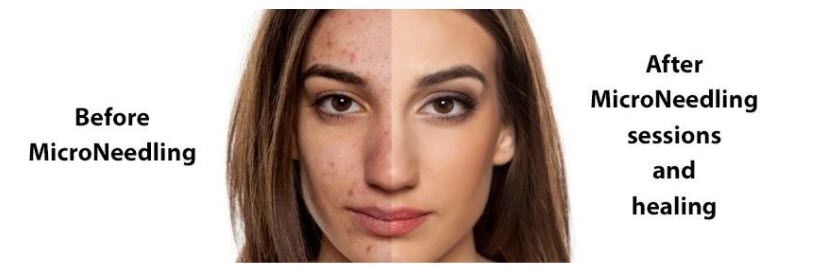 ACM MicroNeedling Facials